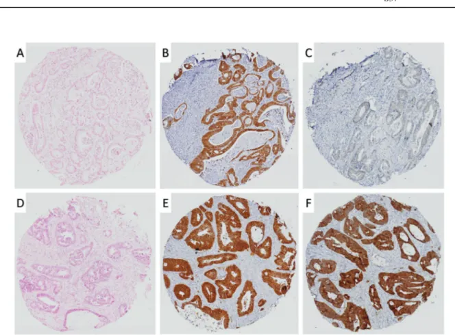 Fig. 3 Staining patterns encountered in CRC tissue microarrays for β-catenin; mutant (a–c), and wild type (d–f) (from left to right: H&amp;E, β-catenin, active β-catenin/ABC)