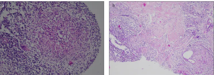 Figure 1. a, b. (a) x200 (b) x100 magnification hematoxylin and eosin stain (H&amp;E) demonstrating perilobular inflammation and granuloma 