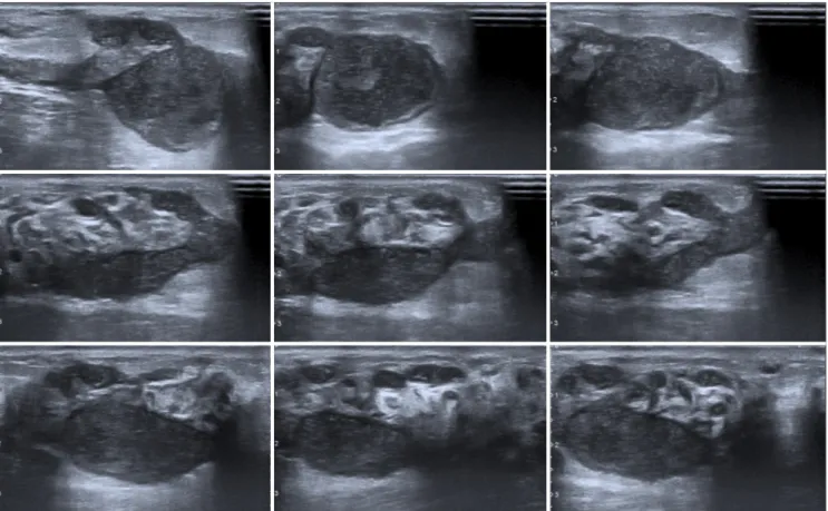 Figure 3. Ultrasound images of a patient with hypoechoic masses containing internal echoes with tubular extensions Table 8