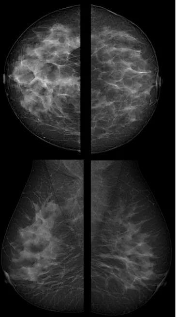 Figure 4. In the mammography of a patient asymmetrically increased 
