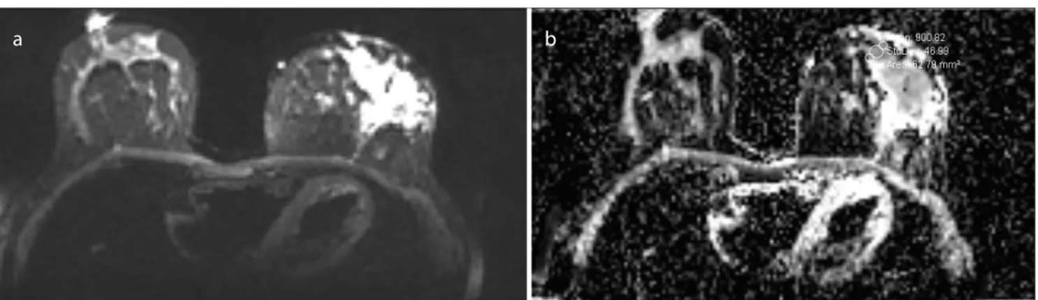 Figure 6. a, b. Diffusion restriction (ADC value: 0.90 mm 2 /s.10 -3 ) of granulomatous mastitis on diffusion-weighted imaging