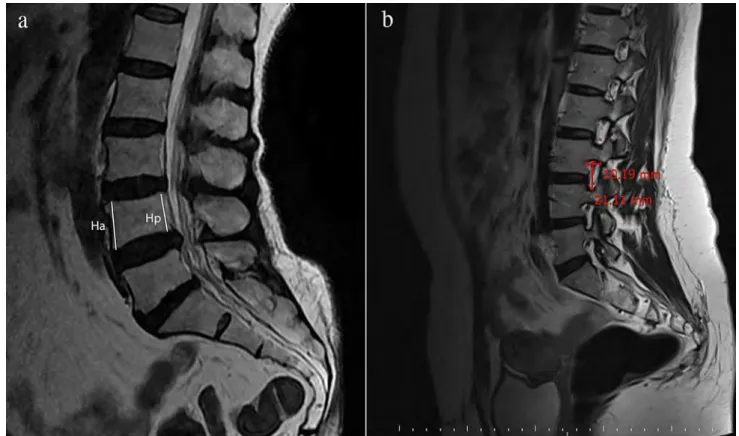 Fig. 1     Anterior and posterior height measurements of the vertebral body (a) and the foraminal measurements (b) are demonstrated