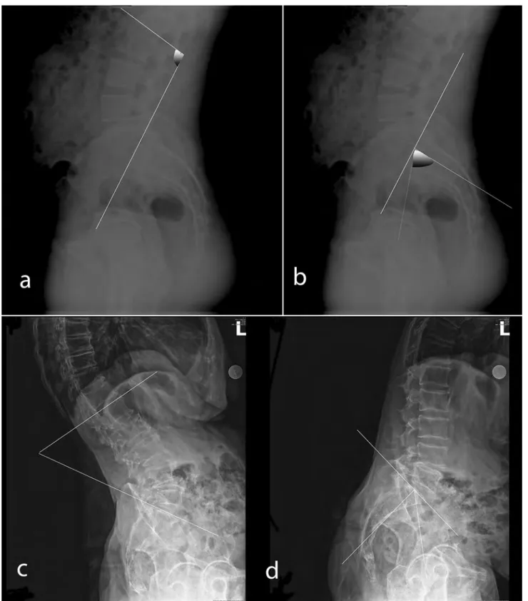 Fig. 2     Lumbar lordosis (LL) angle (a, c) and pelvic incidence (PI) (b, d) measurements are shown