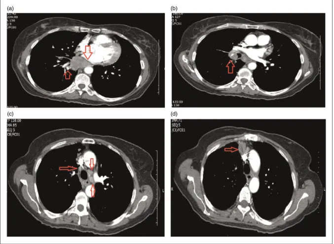 Figure 1. In the axial sections of the thorax computed tomography taken at the time of diagnosis: a malignant mass lesion extending to the subcarinal, paraaortic area is observed in the right hilar region (a), there are large lymph nodes in the right hilar