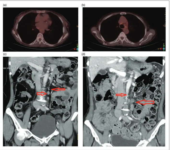 Figure 3. In the F18 FDG-PET/CT examination dated March 2020; It is seen that the mass observed in the right hilar region has disappeared (a)