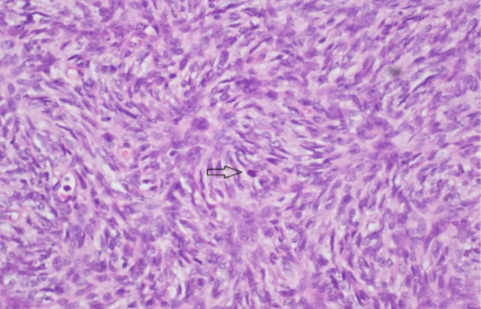 Figure 3. DFSP, storiform pattern of spindle cells with a few mitotic figures. 