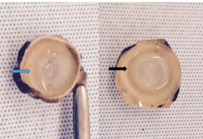 Fig. 3 Entire ciliary body had a white and atrophic appearance in the laser-treated eye (left) compared to untreated eye (right)