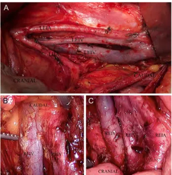 Figure 1: (A) shows a duplication of the left external iliac vein throughout its length, (B) shows a caudal duplication of the right external iliac vein and (C) shows a cranial duplication of the right external iliac vein.