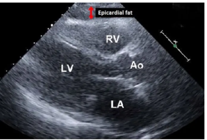 Fig. 1    Echocardiography in the parasternal long-axis view of a  36-year-old male with HS showed an EFT of 7.1 mm