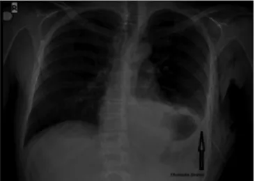 Figure 2: Misplaced tube in the thoracic cavityFigure 1: Diaphragm lesion whether from the tube or penetrating trauma