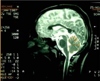 Fig. 2 Delineation of the contour of cerebellum for planimetry