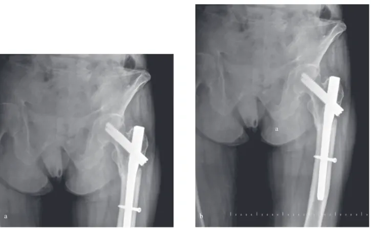 Fig. 2. — (a) AP Radiographs pre-operative and (b) 1 year post-operative, after InterTan fixation of an reverse intertrochanteric 