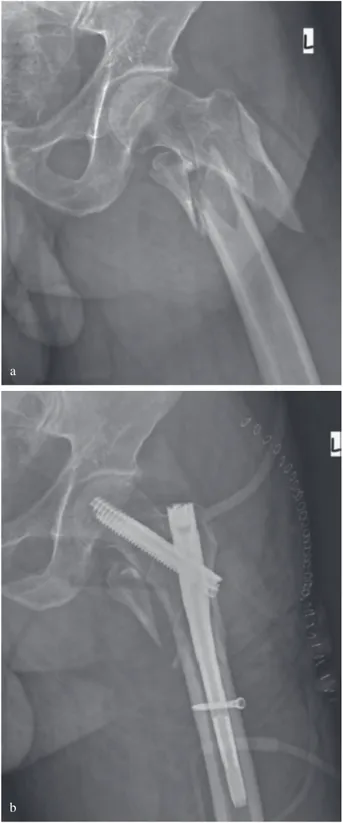 Fig. 3. — (a) AP Radiograph of the left  hip showing a AO/