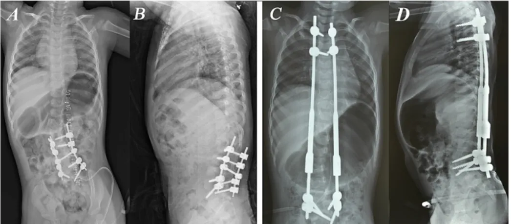 FIGURE 1: Photographs of a two-year-old girl with congenital scoliosis with hemivertebrae.