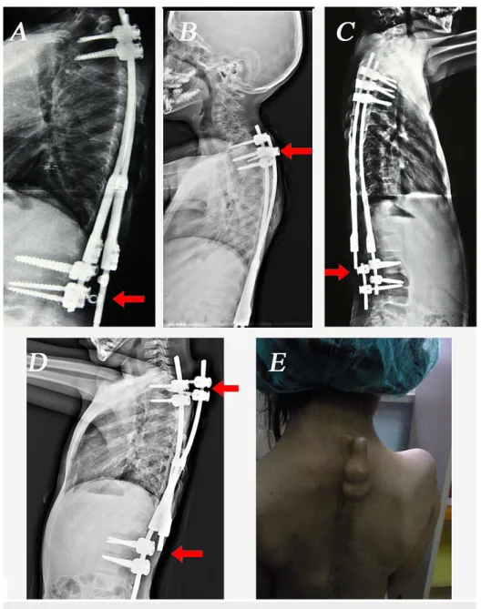 FIGURE 3: The implant-related complications in our patients.