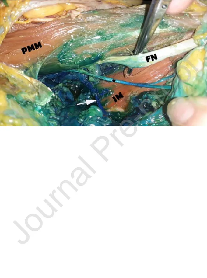 Figure 1 – Distribution  of the methylene  blue in  supine QLB. PMM, Major  Psoas Muscle; 