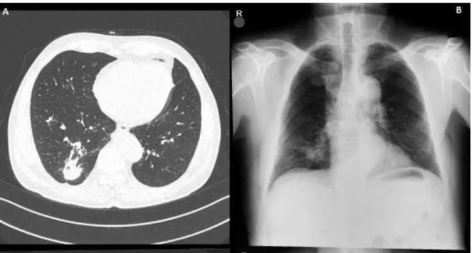Figure 1: an irregular density was observed in the lower segment of the right lung on the 