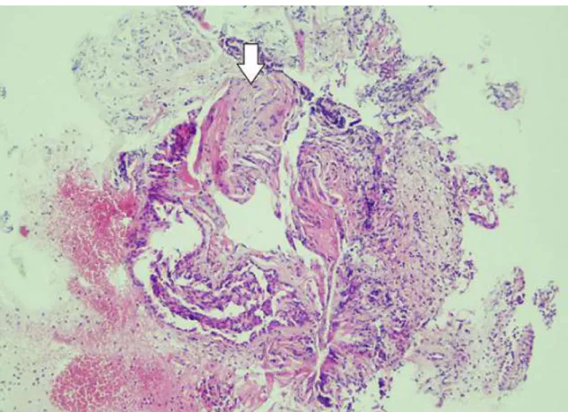 Figure 5: patchy involvement with loose fibroblastic plugs in the second biopsy