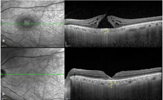 Fig. 2 Preoperative and postoperative EDI-OCT images of a