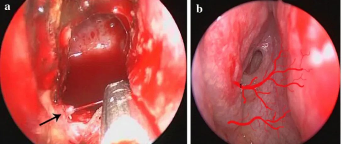 Fig. 3 Anatomical scheme of nasal cavity, origin of the posterior