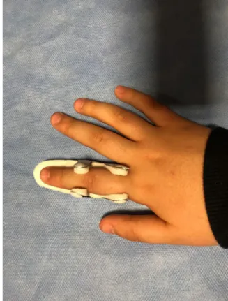 FIGURE 3. The splint method.