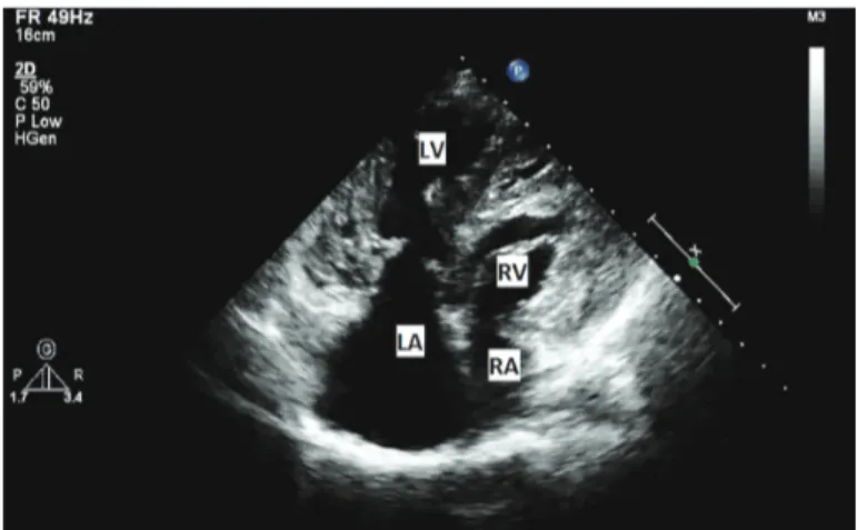 Figure 3. Cardiac magnetic resonance imaging of biventricular non- non-compaction cardiomyopathy