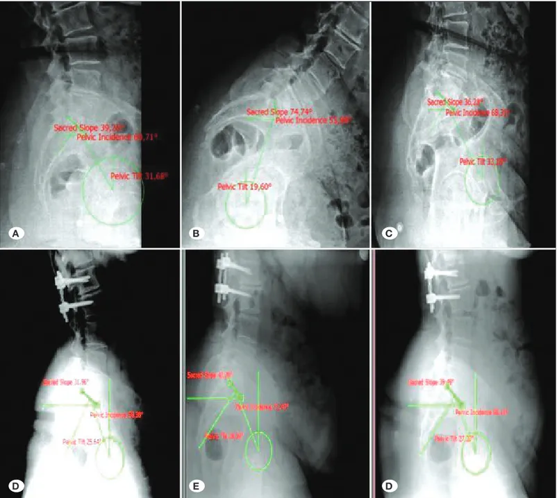 Figure 2: Lateral lumbar spinal radiograps of a patient in neutral (A), flexion (B), and extension (C) positions before surgery
