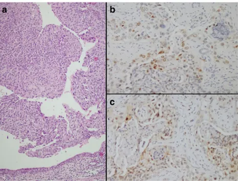 Fig. 1 Papillary pattern and high grade tumor (A:  Hematoxylin-eosin ×10) Immunohistochemical staining in tumor cells (B: p21 immunoexpression, ×20; C: p27 immunoexpression (×20)