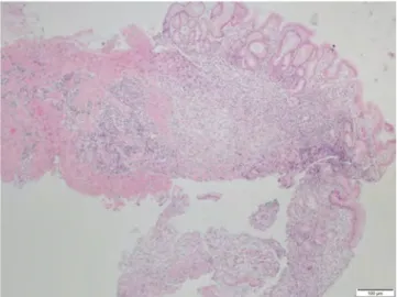 Fig.  1 A.  Small  lymphocytic  infiltration  located  in  the  submu-  cosal  region  by  gastric  endoscopic  biopsy  (hematoxylin  and  eosin, ×100)