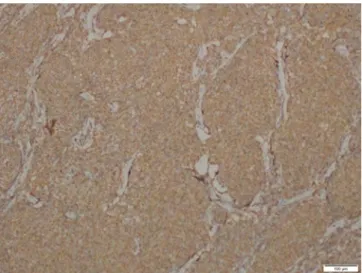 Fig. 2 C. BCL2 positivity (diaminobenzidine, ×100) Fig. 2 D. bcl6 positivity (diaminobenzidine, ×100)