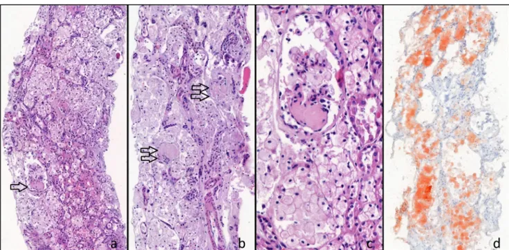 Fig. 1 a –d Diffuse cytoplasmic vacuolization of tubular epithelial cells and glomerular sclerosis are seen