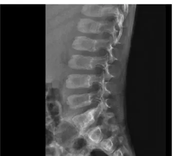 Fig. 1 Anterior beaking of lumbar vertebrae consistent with dysostosis multiplex