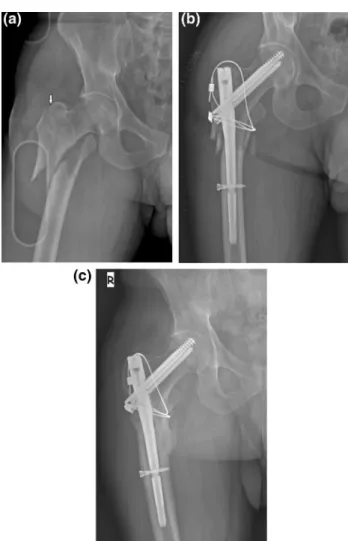 Fig. 2    Extension of the main fracture to the greater trochanter (white  arrow), creating a free LFW fragment (a) and the LFW was reduced  and fixed with two cerclage cable along the lateral cortex and  tro-chanter major (b)
