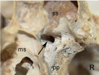 Fig. 1    Oval shaped anterior opening of Vidian canal—arrow anterior  opening of Vidian canal, pp pterygoid process, ms maxillary sinus, ss  sphenoidal sinus, R right side (anterior view)