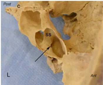 Table 2    The relationship of the Vidian canal with sphenoidal sinus  and body of sphenoid