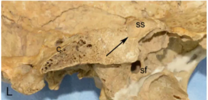 Fig. 10    The pneumatization of sphenoidal sinus was sellar type— arrow and ss sphenoidal sinus, c clivus, L left side (midsagittal plane)