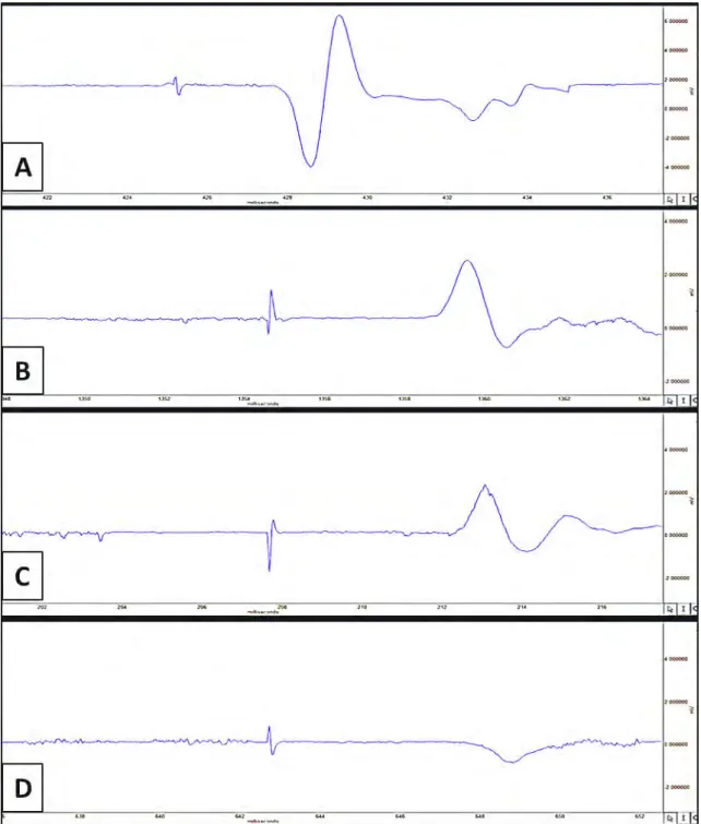 Figure 4. EMG recording samples obtained from (A) control group, (B) autograft group, (C) irradiation group, (D) liquid nitrogen group.
