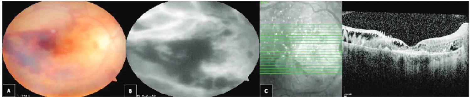 Şekil 1. A) Hastaya ait fundus görüntülerinde, özellikle santral retinada kanama görülmektedir