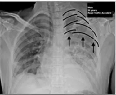 Figure 1: Chest X-ray (PA view) multiple rib fractures (arrows).