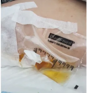 Fig. 2 A sterile disposable paediatric urine collection bag with 100-cc capacity was used for collection of draining fluid from drain exit point