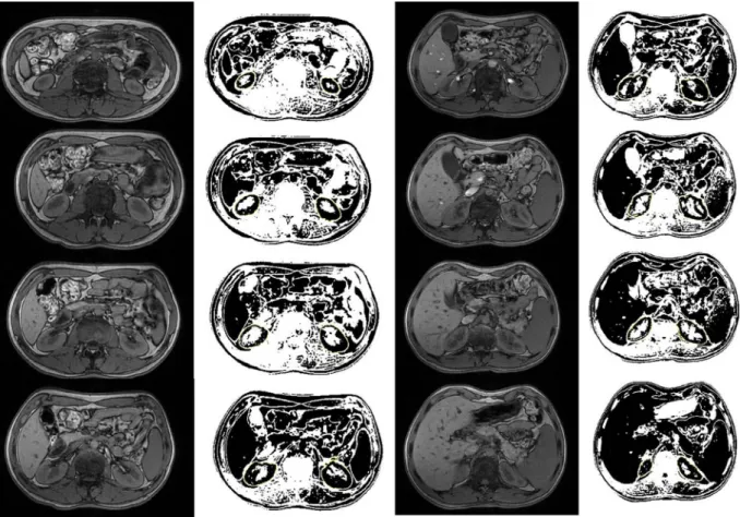 Fig. 1. Calculation of the [28_TD$DIFF]KV using the ImageJ. Delineation the boundaries of the kidney