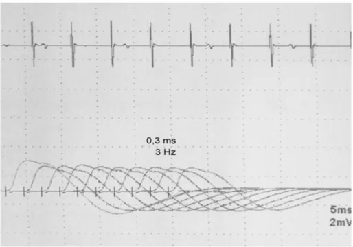 Figure 1: RNS Example Recorded From SA Muscle 