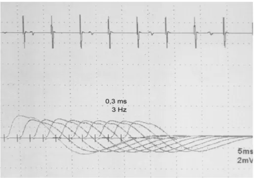 Figure 1: RNS Example Recorded From SA Muscle 