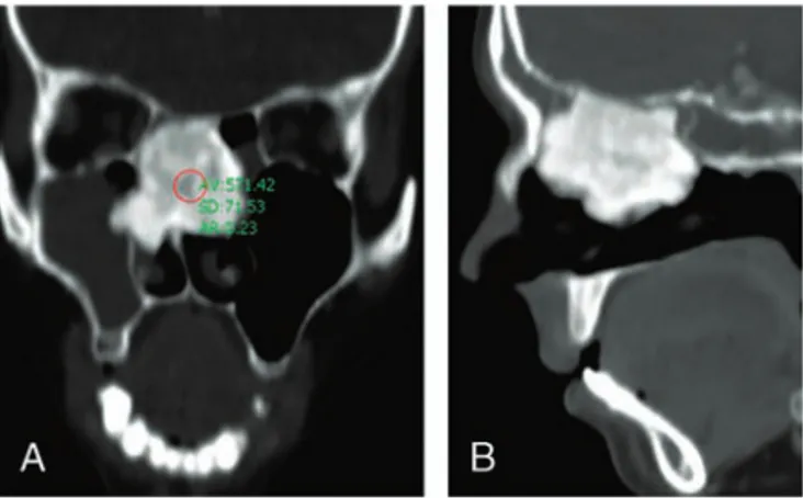 FIGURE 2. The picture of the transnasally excised osteoma.