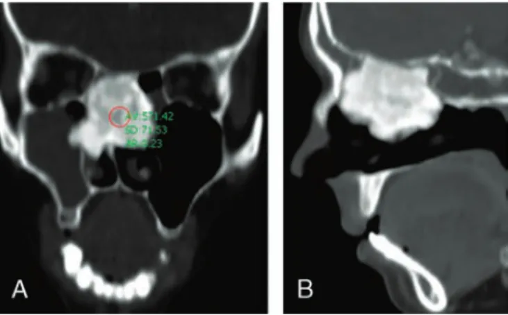 FIGURE 2. The picture of the transnasally excised osteoma.