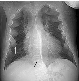 Figure 1 Expansion in the ribs forming the suspected mass on both  sides (white arrow) and scattered losses of height in the vertebrae  (black arrow) observed on the posterior anterior (PA) pulmonary  radiograph.