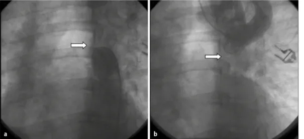 Fig. 1  9  Aortography  showing the distal portion  of the interruption (a, 