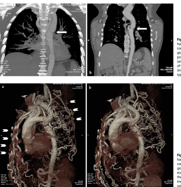 Fig. 2  9  a, b Contrast-en- Contrast-en-hanced, three-dimensional  computed tomography  an-giogram reveals severe  hy-poplasia of the aortic arch  (arrow) distal to the origin  of the left subclavian artery  (interrupted aortic arch,  type A)