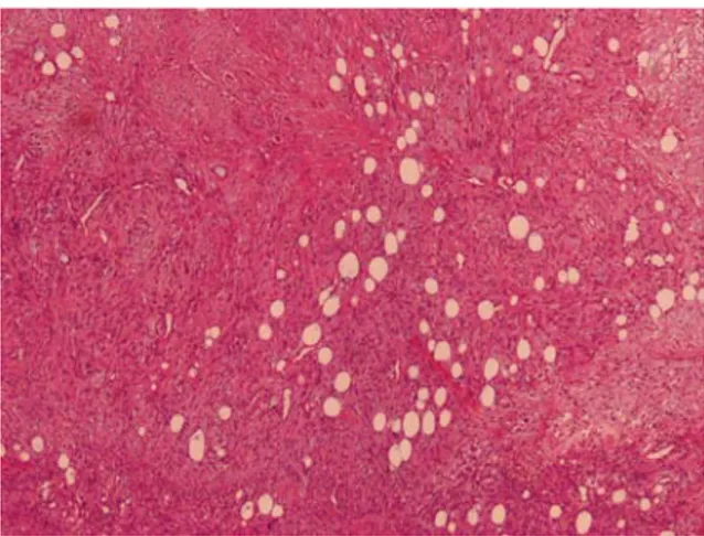 Figure 2: SMA positive immunostaining of cells of  nodular fasciitis. Magnification = 40 ×.