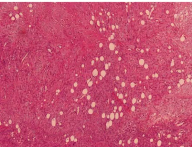 Figure 2: SMA positive immunostaining of cells of  nodular fasciitis. Magnification = 40 ×.